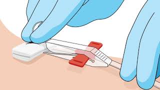 MasterGuard Apheresis Needle Removal Video [upl. by Denae]