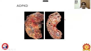 Cystic disease of kidneyDrJPriyadharisini [upl. by Delmer]