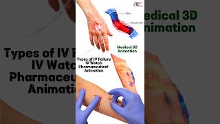 Types of IV Failure IV Watch Pharmaceutical Animation medical animation3d short BiologywithAliya [upl. by Tamqrah]