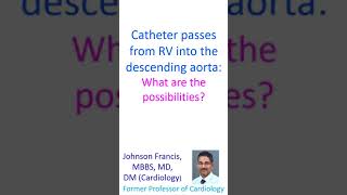 Catheter passes from RV into the descending aorta What are the possibilities [upl. by Atekram391]