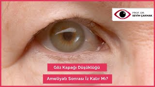 Göz Kapağı Düşüklüğü Ameliyatı Sonrası İz Kalır Mı  Göz Kapağı Düşüklüğü  Prof Dr Sevim Çakmak [upl. by Tabbitha13]