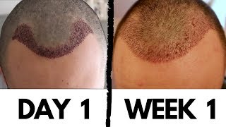 Hair Transplant Results after 1 Week  How to Remove Scabs and Dry Skin of Implanted Area DHI [upl. by Beauchamp789]