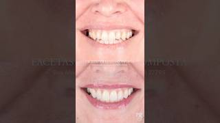 ORTODONTIA E ESTÉTICA DENTAL dentista invisalign facetas [upl. by Chemar691]