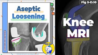 Fig 5D10 Aseptic Loosening [upl. by Mayce]