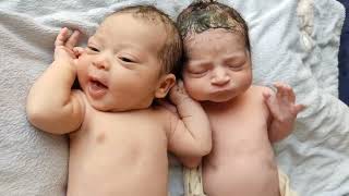 Down Syndrome baby with Normal Twin baby just after birth viral baby love music usa [upl. by Ettevets]