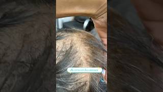 It’s that KTips Magic Seamless Alopecia Illusion Transformation alopeciastylist ktipextensions [upl. by Eduard]