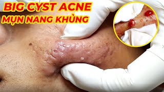 Điều trị mụn nang hiệu quả tại TPHCM  Cyst Acne Treatment  Hiền Vân spa Đỗ Thu Hiền  662 [upl. by Atikim747]