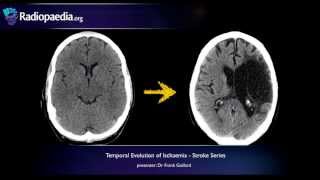 Stroke Evolution from acute to chronic infarction  radiology video tutorial CT MRI [upl. by Boor]