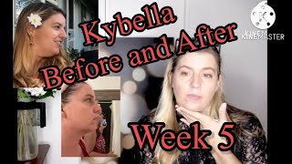 KYBELLA BEFORE AND AFTER Double Chin Removal LifeQuestBeauty [upl. by Akedijn538]