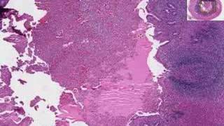 Histopathology Acute Appendicitis [upl. by Berta]