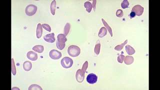 Schistoctyte Helmet Cells Sickle Cell amp Spherocyte [upl. by Elinore]