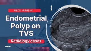 Endometrial Polyp on Transvaginal ultrasound  Radiology case 6 [upl. by Agee]