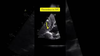 Subcostal View Showing Thrombus in IVC in a patient with Hepatocellular Carcinoma echocardiography [upl. by Banky]