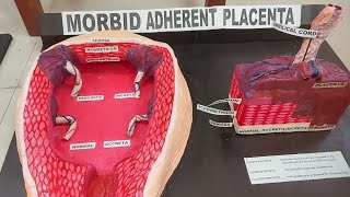 Morbidly Adherent Placenta Accreta Increta amp Percreta [upl. by Bobbee]