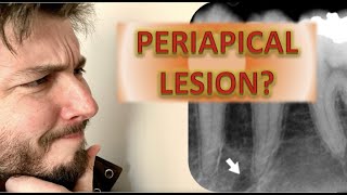 How to Identify a Periapical Radiolucency Abscess Cyst Granuloma Root canal infection x rays [upl. by Rehsa]