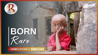 Progeria Boy Nothing is impossible for me [upl. by Jankey]