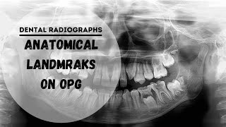 Dental panoramic radiographs  OPG  DPT Anatomical Landmarks [upl. by Columba318]