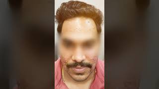 Severe Acne Treatment  3Month Transformation by Dr Amit Kerure  Navi Mumba [upl. by Yerkovich]