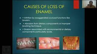 Dental Hypersensitivity [upl. by Amice]