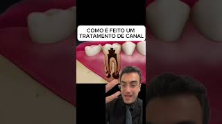 Como é feito um tratamento de canal odonto tratamentodecanal endodontia [upl. by Leirvag137]