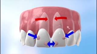 Discover how Invisalign works [upl. by Eniowtna]