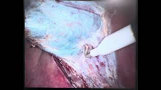 Laparoscopic cholecystectomy 2x unedited [upl. by Enyluqcaj225]