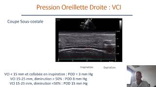 Evaluation de la fonction diastolique en échocardiographie transthoracique [upl. by Darach]