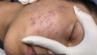 ACNE TREATMENT VU QUYNH MI  Blackheads On Boy Face 2024FULL [upl. by Sairu]