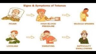 Clinical Features Signs and symptoms of Tetanus [upl. by Angle]