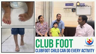 Successful Clubfoot treatment In Delhi ll टेडे मेड़े पाँव का इलाज clubfoot [upl. by Kinnie]