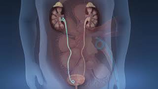 Shockwave Lithotripsy [upl. by Adi]