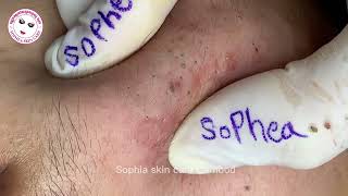 Acne facial removal treatment by Sopheaskincarecambodia 14th December 2023 [upl. by Ordnas]