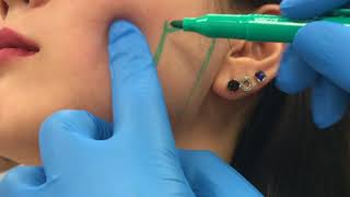 Treating enlarged masseter muscles with Botox by Dr Shaun Patel [upl. by Kellie39]