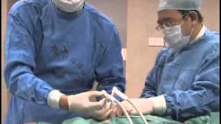 Cryosurgery at Fuda Cancer Hospital [upl. by Agustin]