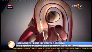 Premieră în România implantare de valvă aortică printro incizie de 5 cm în dreptul inimii [upl. by Kapor]