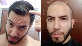 COMB OVER vs BUZZ CUT TRANSFORMATION for Balding Man [upl. by Thorin]