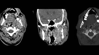 TMT Neck Imaging by Dr Jyoti Kumar Masticator Spaces [upl. by Kafka]