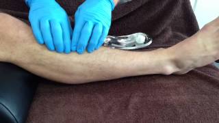 Dry Needling Tibialis Anterior [upl. by Rayford]