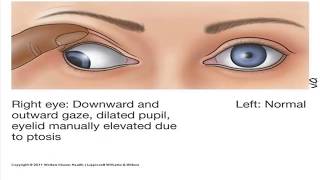 How to remember Cranial Nerves part 4 Abducens CNVI and Oculomotor nerve CNIII [upl. by Notfilc]