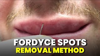 How to remove Fordyce Spots  Fordyce Spots Removal with NEEDLE METHOD Tutorial [upl. by Bella58]