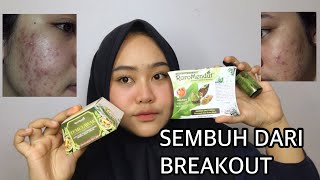 RORO MENDUT SKINCARE UNTUK JERAWAT Ampuh  Erselita [upl. by Eittocs114]