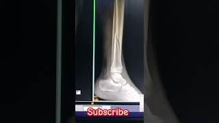 Left Leg fracture Xray shorts viral medical student supporttrending craft me [upl. by Norven]