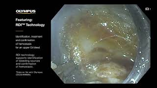 Identify Bleeding Points with RDI™ Technology [upl. by Hathcock178]