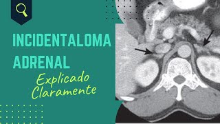 Incidentaloma adrenal [upl. by Hoopes214]