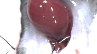 Hetrotopic Heart Transplant [upl. by Aitahs]