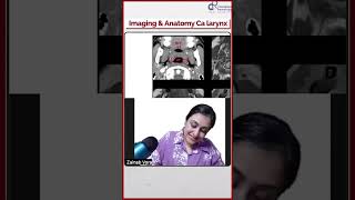 Imaging amp Anatomy of CA Larynx by Dr Zainab Vora  Conceptual Radiology [upl. by Nylcoj]