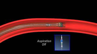 Thrombectomy animation [upl. by Notnek772]