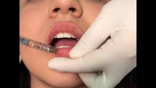 Juvederm Volbella injection to the Lips Lip Augementation [upl. by Ahsauqram]