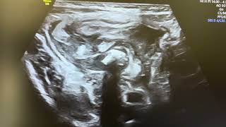 Ultrasound of Ruptured appendix fecolith  collection Apndx covred wid bowel loop lump [upl. by Adnauqal]