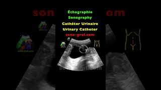 Échographie  Cathéter Urinaire [upl. by Arette]